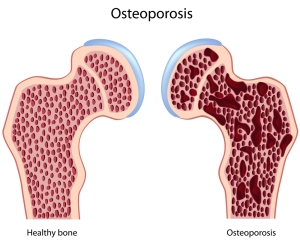 Osteoporosis-bone